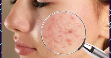 Best Way To Prevent Acne