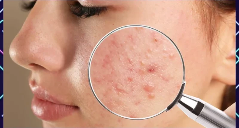 Best Way To Prevent Acne