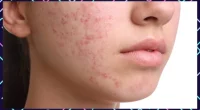 Best Way To Live With Teenage Acne