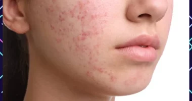 Best Way To Live With Teenage Acne