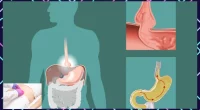 11 Things That Can Help You Avoid Hernia Complications Completely