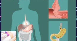 11 Things That Can Help You Avoid Hernia Complications Completely