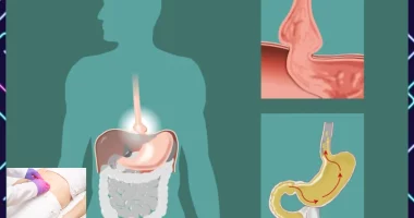 11 Things That Can Help You Avoid Hernia Complications Completely