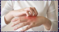 Psoriasis: Causes, Treatment And Complications