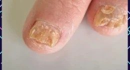 Summer Fungal Infections: Causes and Protection Tips for Kids