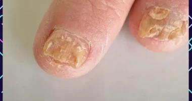 Summer Fungal Infections: Causes and Protection Tips for Kids