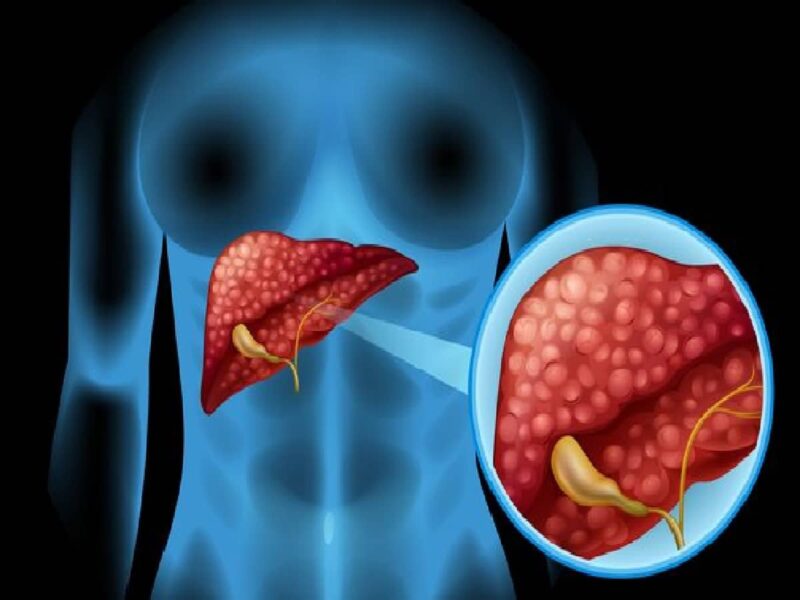 about-30-of-the-population-in-india-have-fatty-liver-disease-doctors