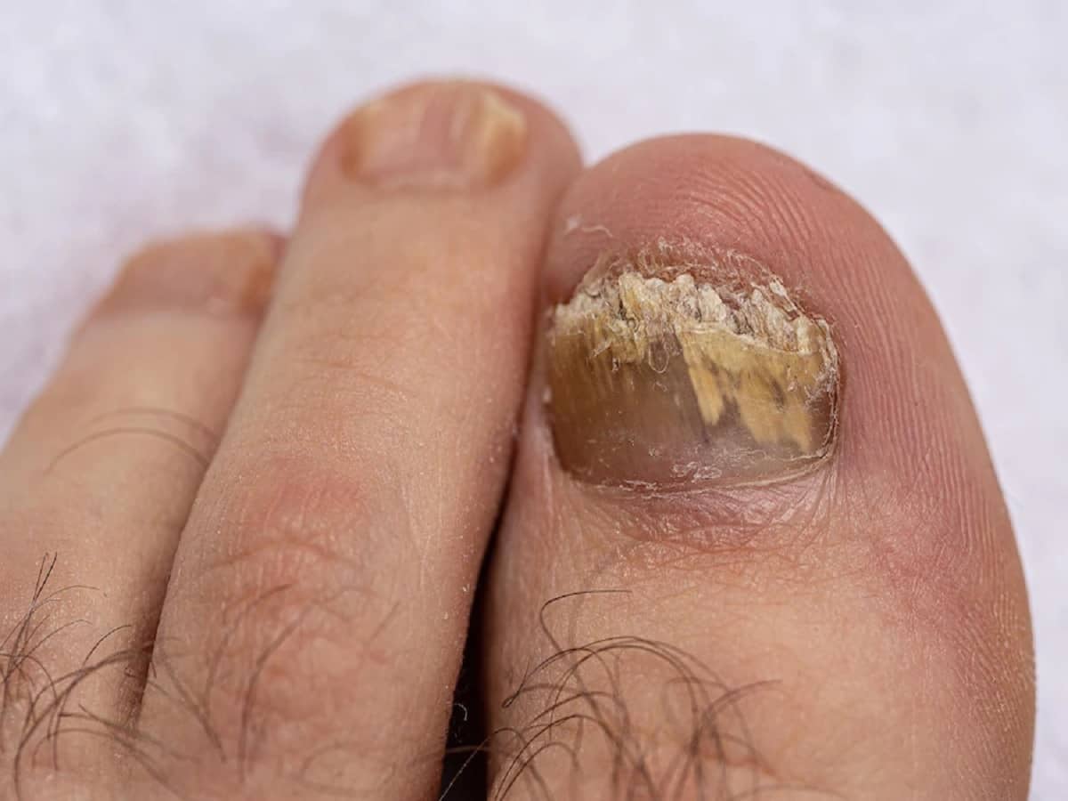 Common Fungal Infections In Summer And Their Causes - Learn How To Protect Kids