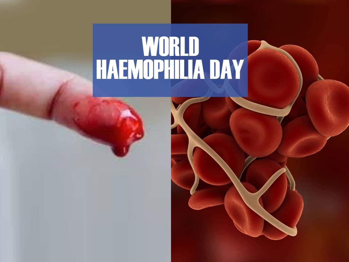 Living With Haemophilia? Here’s Everything You Need to Know About The Condition