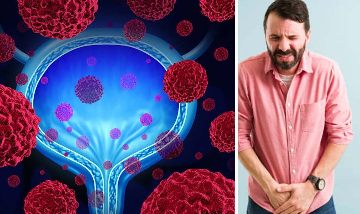 bladder-cancer-symptoms-four-changes-in-your-pee-that-are-common