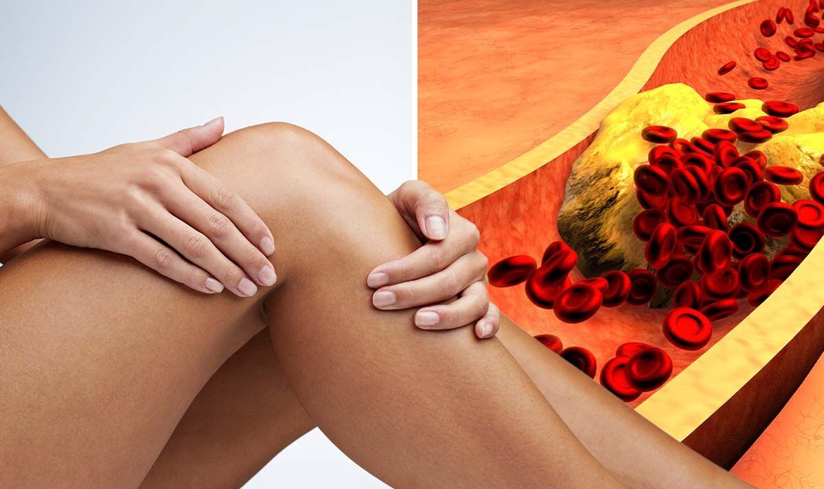 High cholesterol Can you feel that? The ‘painful’ sign in your legs