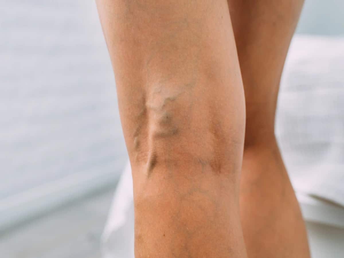 5 Factors That Can Cause Varicose Veins