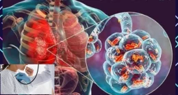 Preventing Pneumonia: Strategies to Avoid Serious Lung Infections