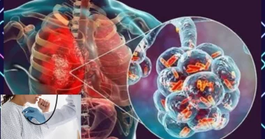 Preventing Pneumonia: Strategies to Avoid Serious Lung Infections