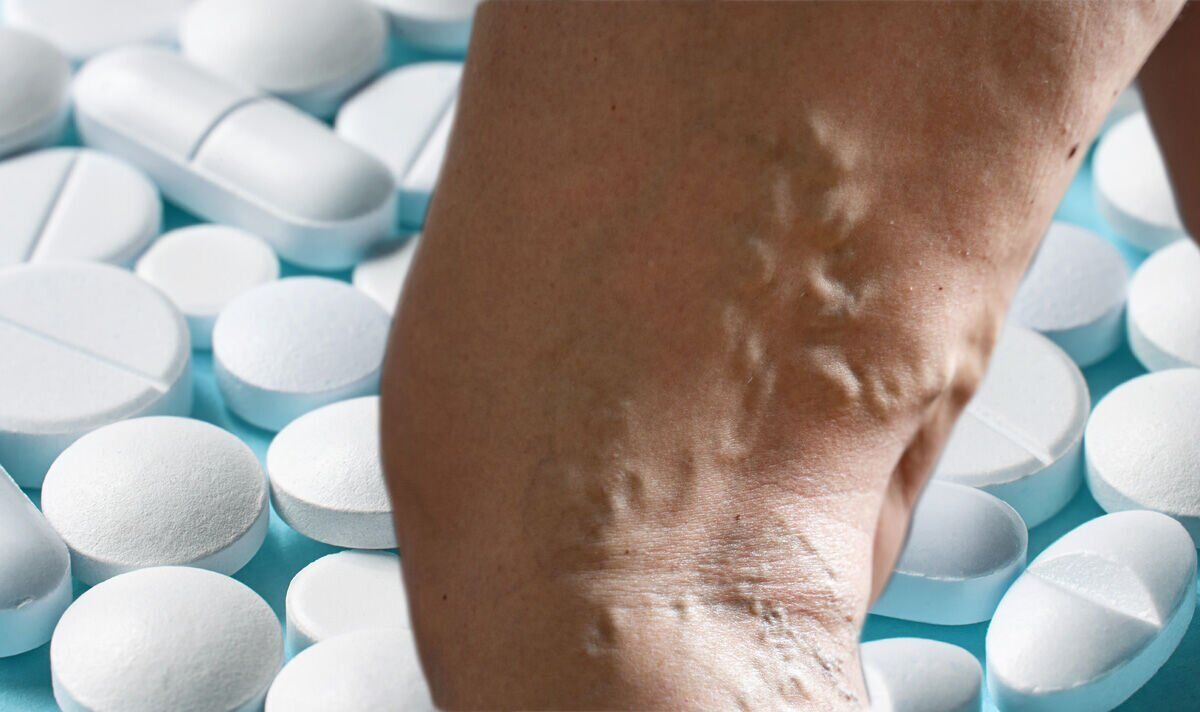 Blood clots The two vitamin shortages linked to varicose veins and