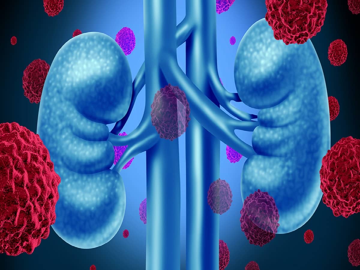 Kidney Cancer: Types, Symptoms, Diagnosis And Treatment