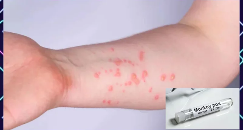 Is Monkeypox Dangerous And The Next Pandemic? How It Compares To COVID-19