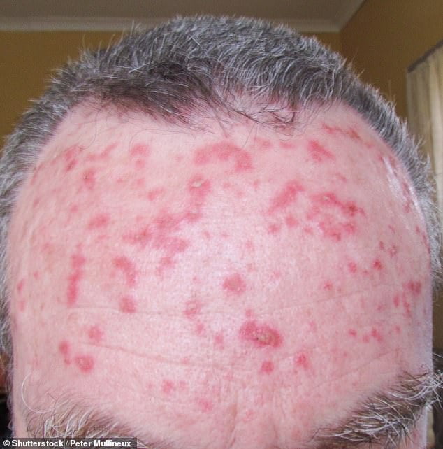 How do I heal the scaly patches on my head? Dr MARTIN SCURR answers ...