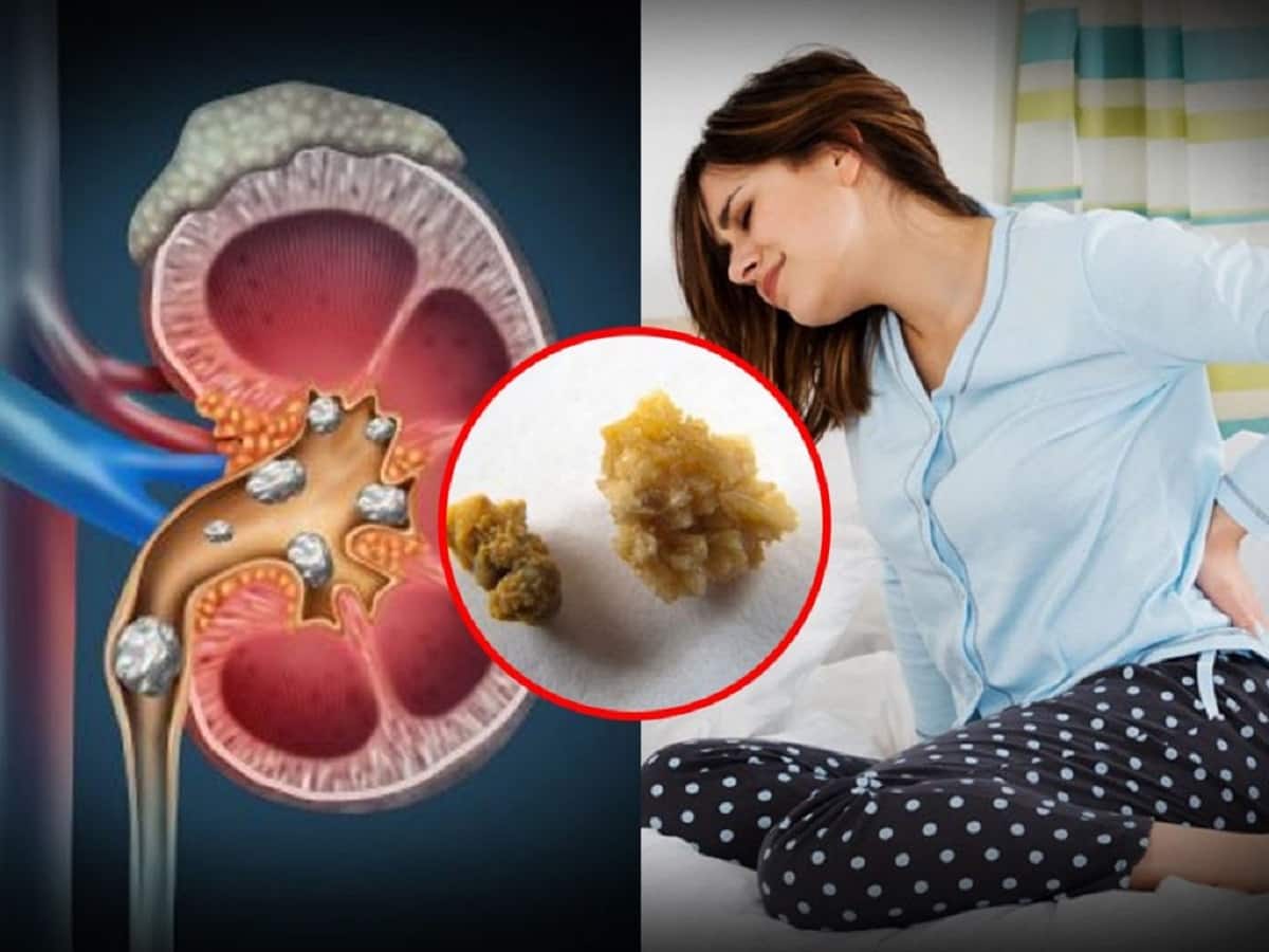 Get Rid Of Kidney Stones With The Right Nutrition: Things You Need To Know