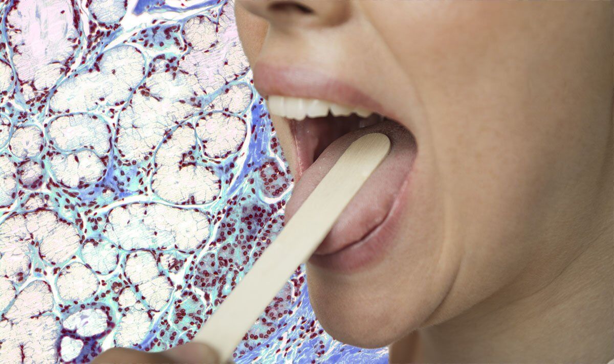 Vitamin B12 deficiency The sign that affects 'more than 50' of the