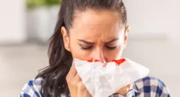 What to do if you can’t stop the nosebleed