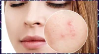 Adult Acne: How Is It Different From Teenage Zits?