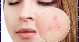Adult Acne: How Is It Different From Teenage Zits?