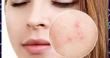 Adult Acne: How Is It Different From Teenage Zits?