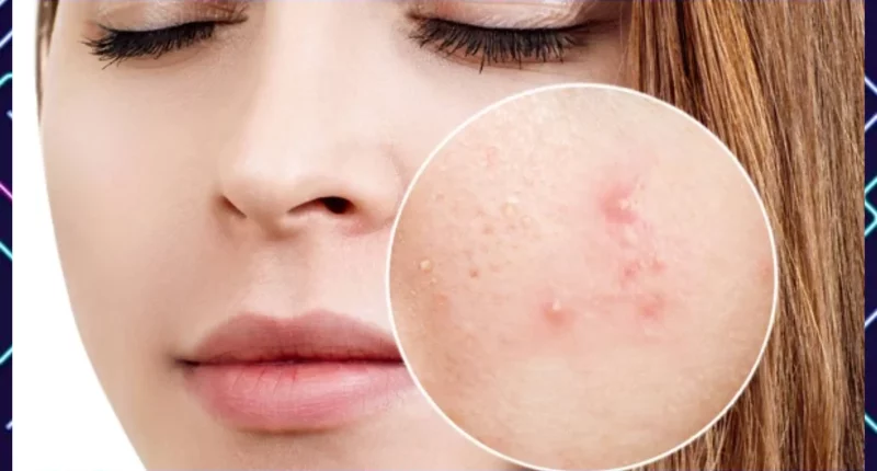 Adult Acne: How Is It Different From Teenage Zits?