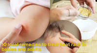 10 local remedies to treat heat rash in babies and adults