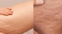 Home remedy for cellulite removal on thighs you can try now