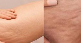 Home remedy for cellulite removal on thighs you can try now