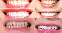 Disadvantages Of Teeth Cleaning: What You Need To Know