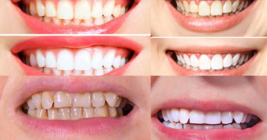 Disadvantages Of Teeth Cleaning: What You Need To Know