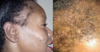 5 Things That Damage Your Hair and Hairline As An African Women