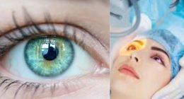 How Long After Cataract Surgery Can You Drive?