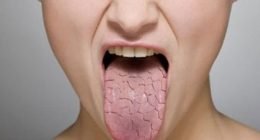 Sjogren's syndrome foods to avoid for optimal health