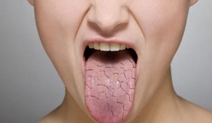 Sjogren's syndrome foods to avoid for optimal health