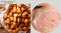 11 Incredible Side effects of Eating chin chin - Nigerian Snack