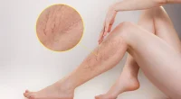 7 Conditions Spider Veins are Signs of