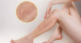 7 Conditions Spider Veins are Signs of