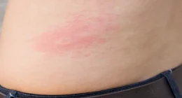 Herpes Skin Rash Causes, Symptoms, and Treatment