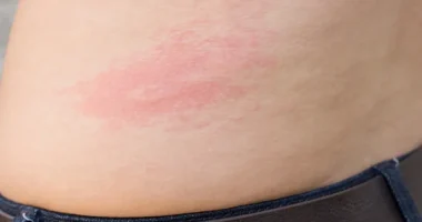 Herpes Skin Rash Causes, Symptoms, and Treatment