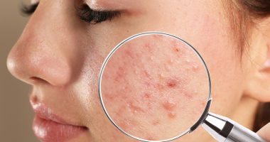 Different Types of Skin Diseases: Causes, Symptoms, and Treatment Options