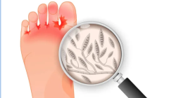 Athlete's Foot Condition: Symptoms, Causes and Treatment 