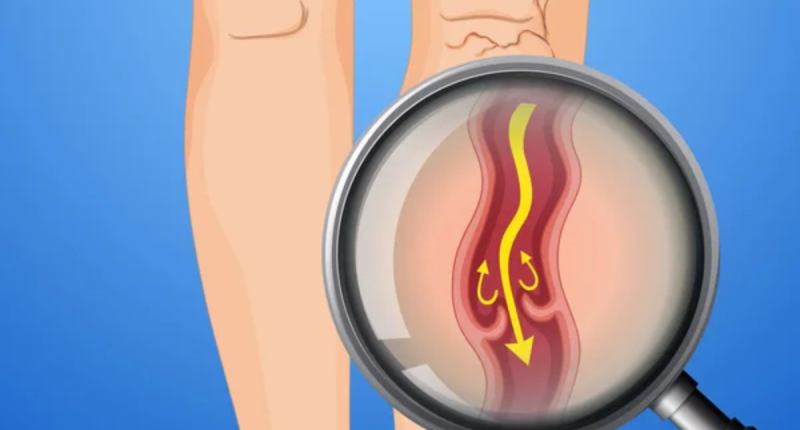 Deep Vein Thrombosis: Symptoms and Treatment Options