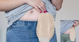 What Happens To Your Anus After Colostomy