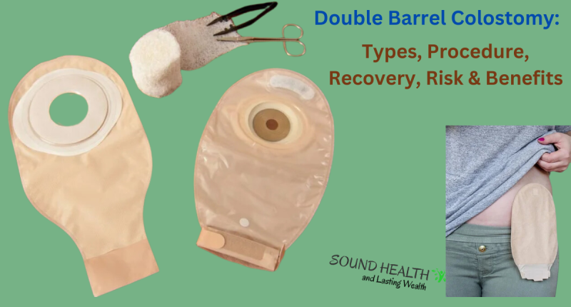 Double Barrel Colostomy: Types, Procedure, Recovery, Risk & Benefits ...