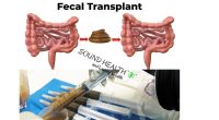 Fecal Transplant: History, Types, Procedure, Risk & Benefits