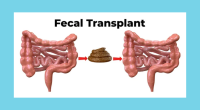 Does fecal transplant work for weight loss